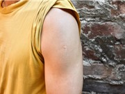 Vaccine mRNA có tiềm năng chống lại bệnh lao